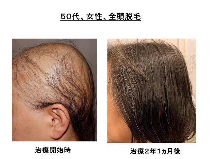円形脱毛症　病院